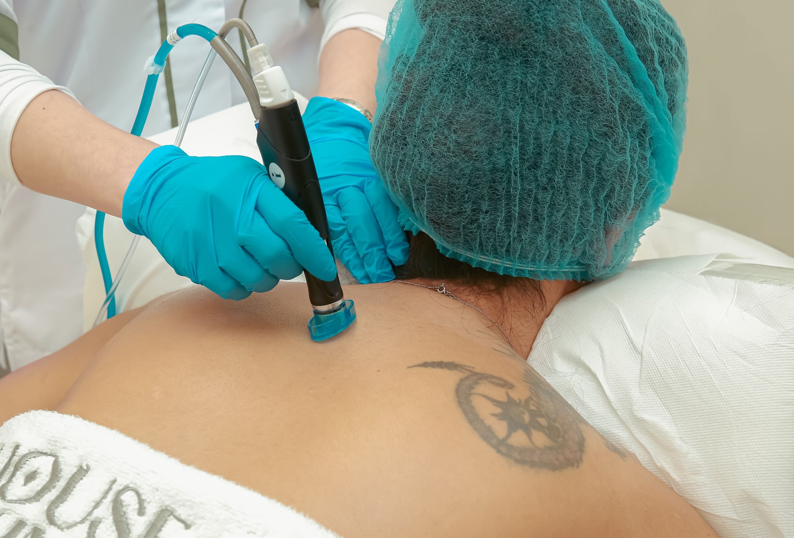 Détatouage laser Picoseconde Lutronic tatouages noirs et couleurs